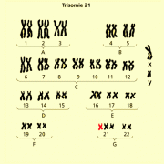Karyogramm des Chromosomensatzes bei Trisomie 21: Das 21. Chromosom ist in dreifacher Ausführung vorhanden. 