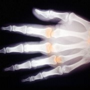 Röntgenaufnahme einer Hand (um 1900) 